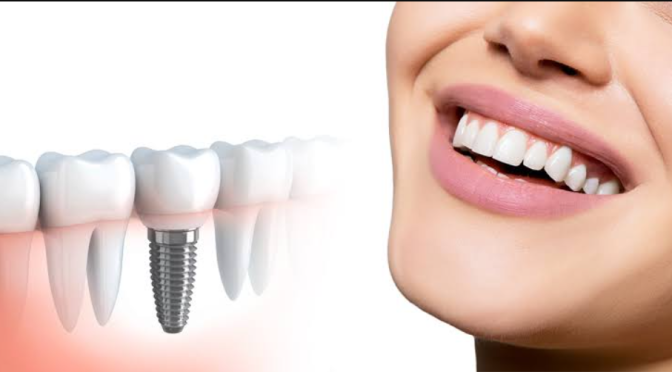 How to Choose a Clinic for Dental Implants